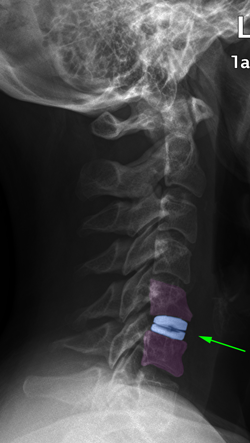 Cervicalarthro1