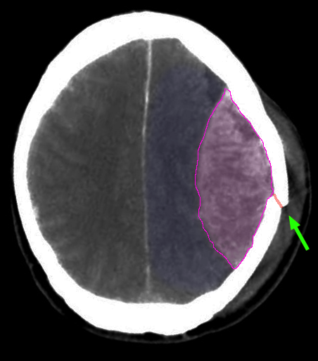 Epidural