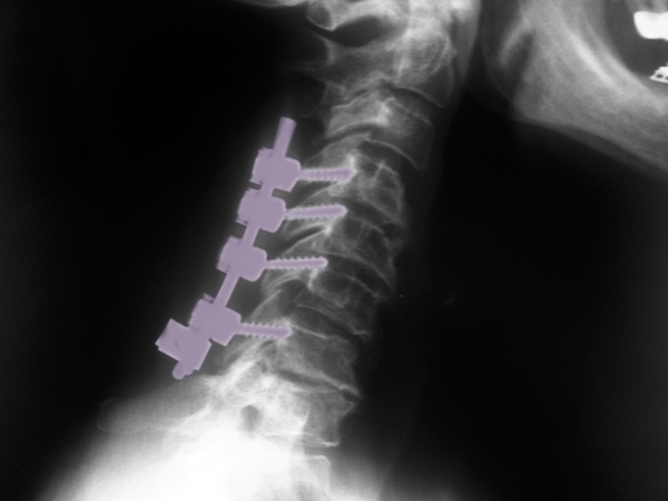 PCF2